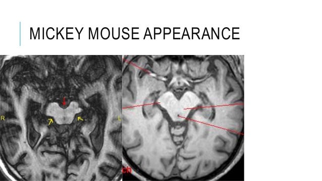 Use no wonder in a sentence Mickey mouse appearance midbrain